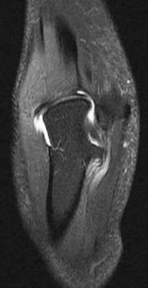 Figure 4 for case Ulnar neuritis and denervation of the flexor digitorum profundus